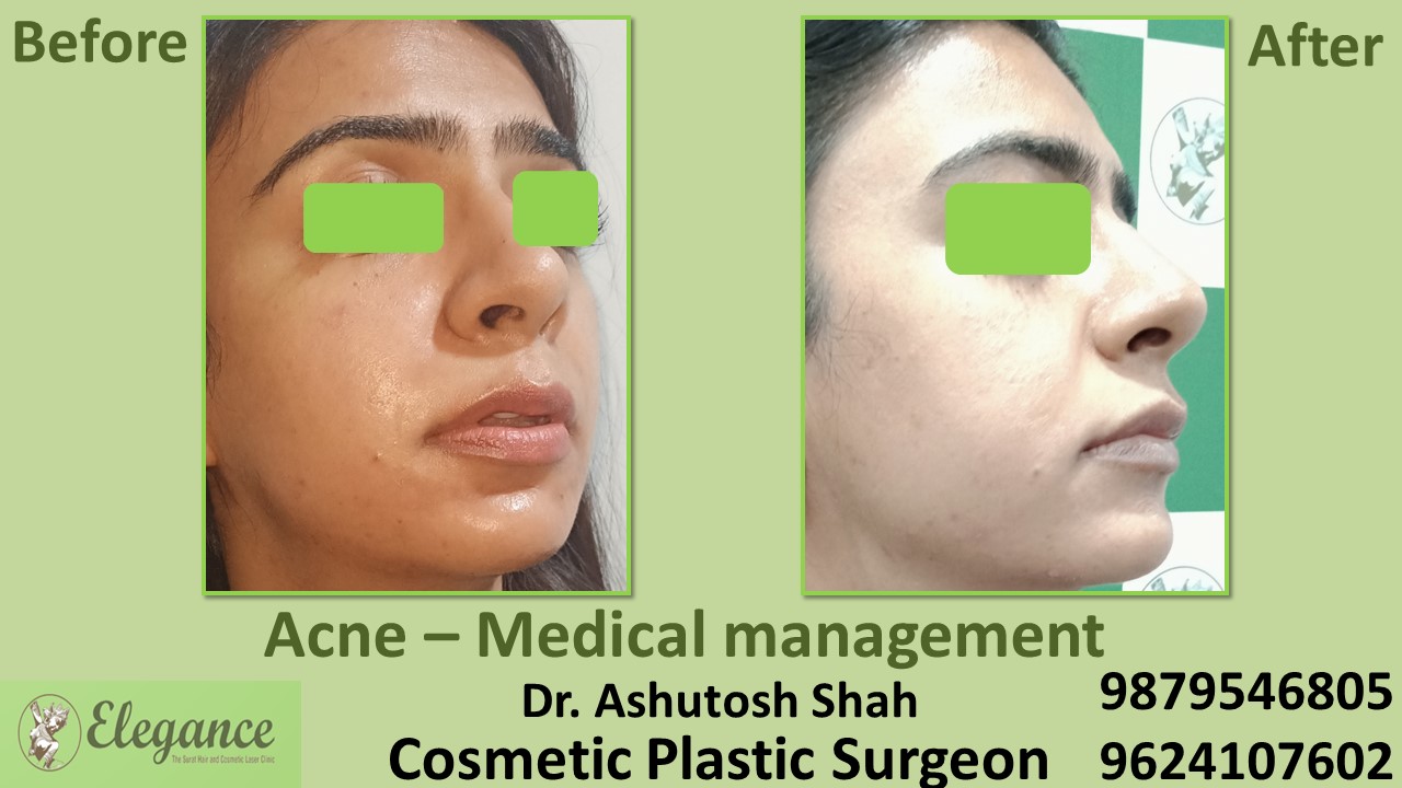 Acne And Pigmentation Scars Treatment In Adajan, Vesu, Piplod, Surat.