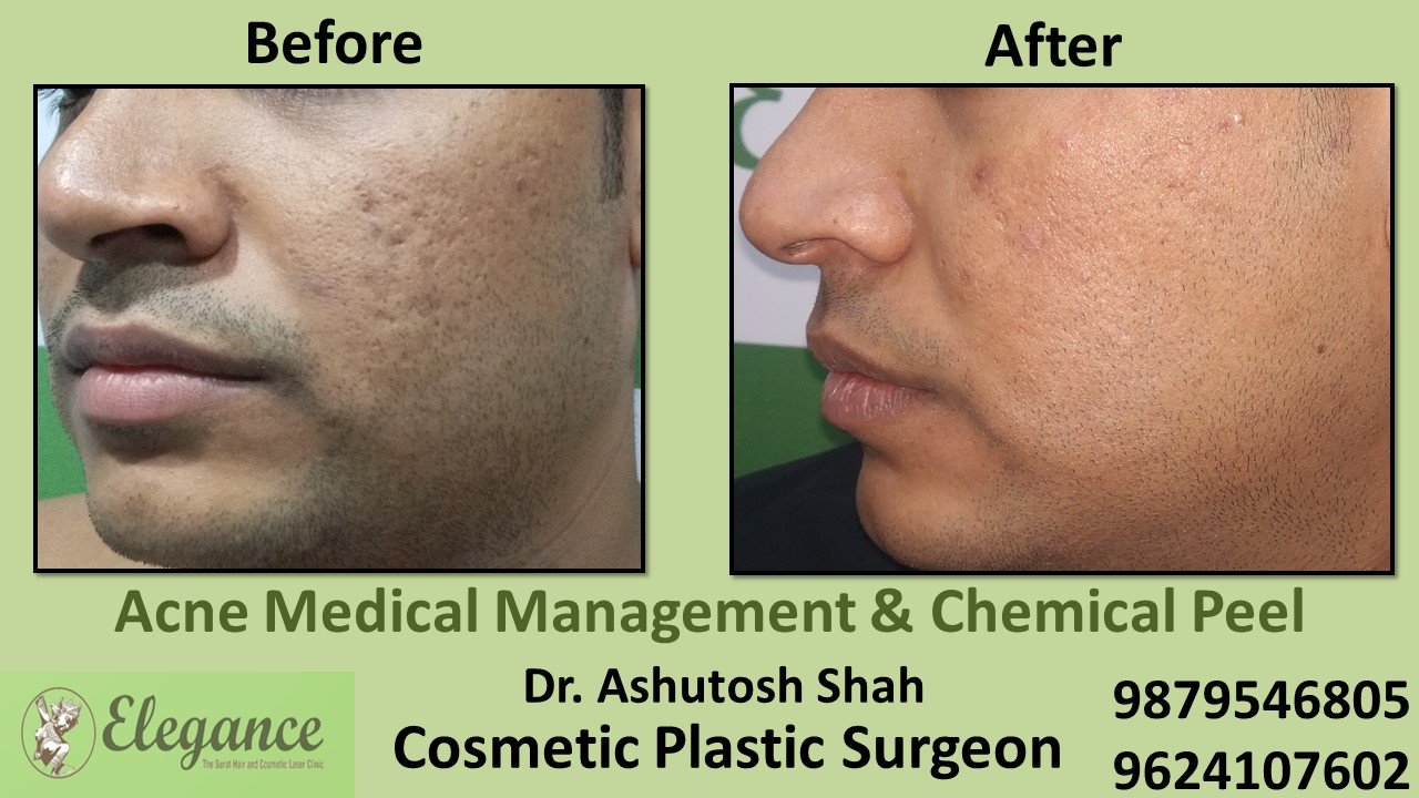 Acne - Chemical Peel, Bharuch, Gujarat, India.