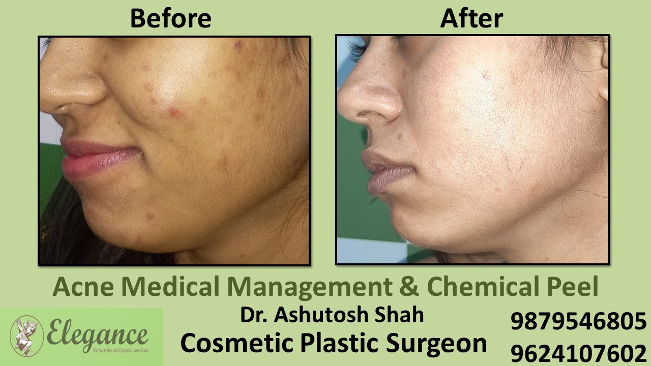 Acne - Chemical Peel, Chikhli, Gujarat, India.