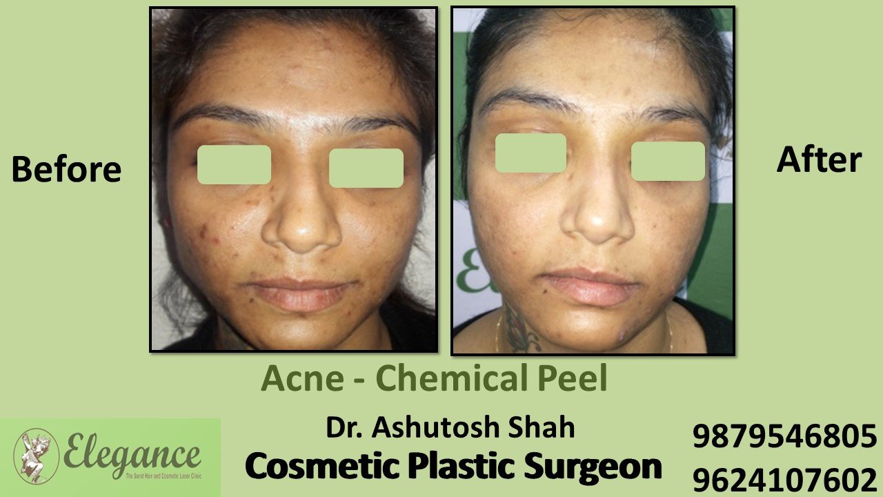 Acne - Chemical Peel, Daman, Gujarat, India.