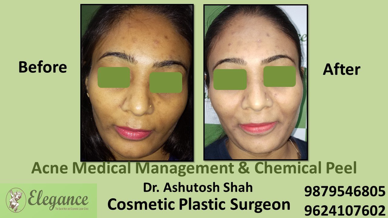 Acne - Chemical Peel, Hazira, Gujarat, India.