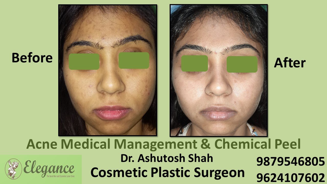 Acne - Chemical Peel, Kosamba, Gujarat, India.