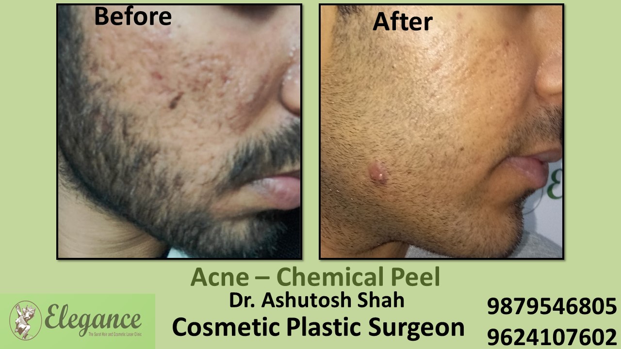 Acne - Chemical Peel Treatment, Ankleshwar, Gujarat, India.