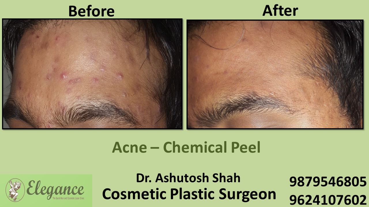 Acne - Chemical Peel Treatment, Bharuch, Gujarat, India.