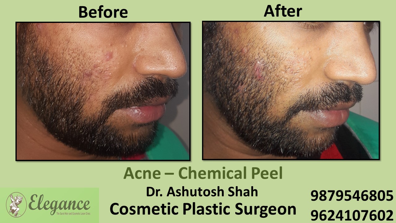 Acne - Chemical Peel Treatment, Surat, Gujarat, India.