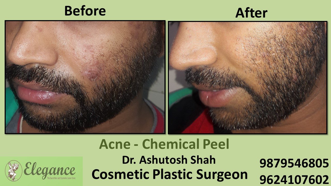 Acne - Chemical Peel Treatment, Valsad, Gujarat, India.