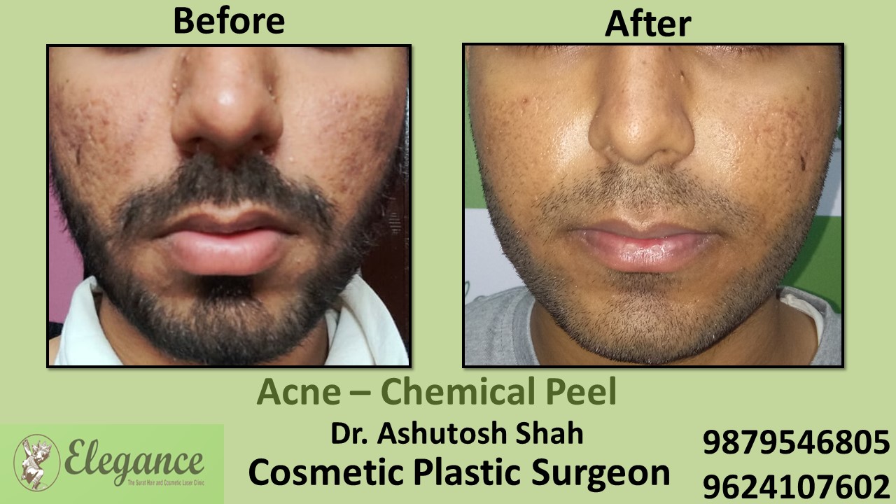 Acne - Chemical Peel Treatment, Vdodara, Gujarat, India.