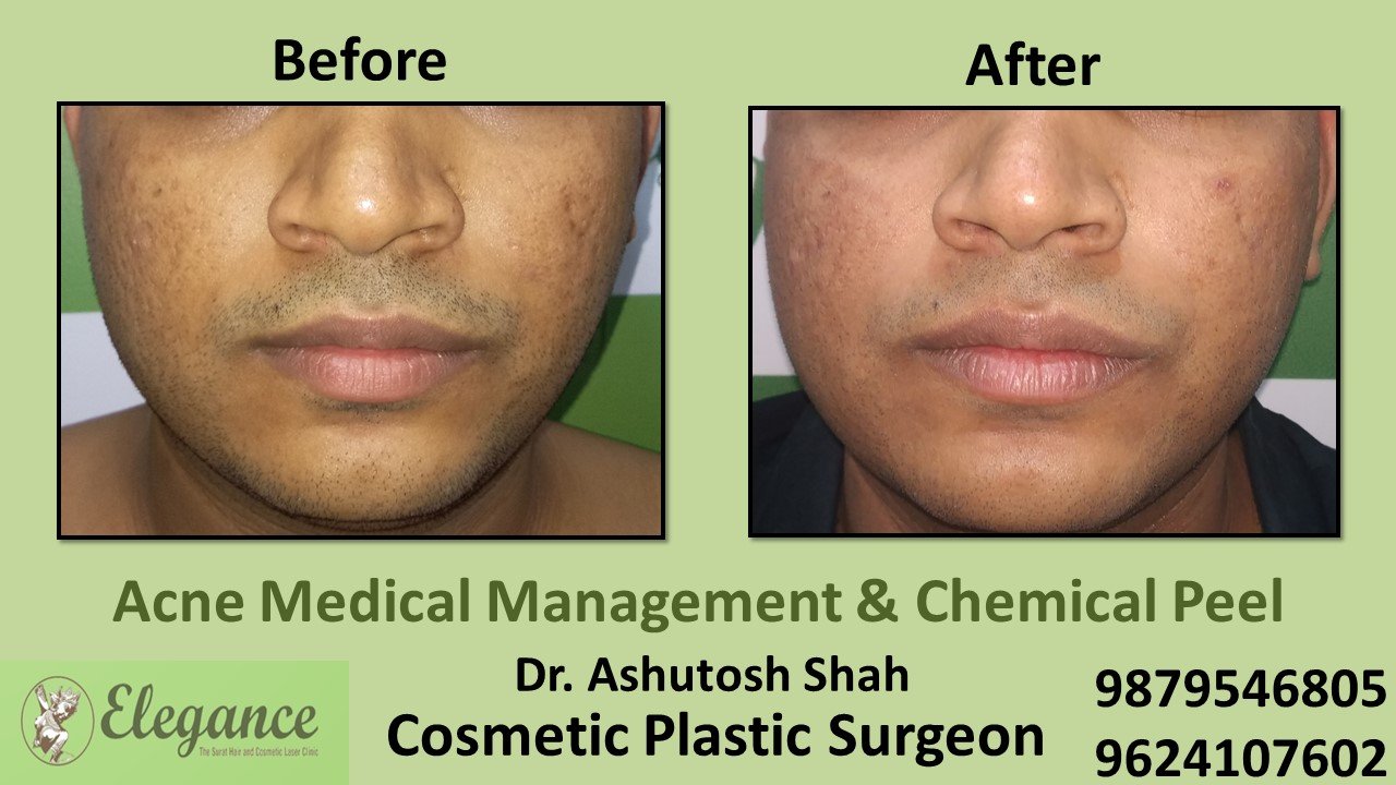 Acne - Chemical Peel, Vadodara, Gujarat, India.