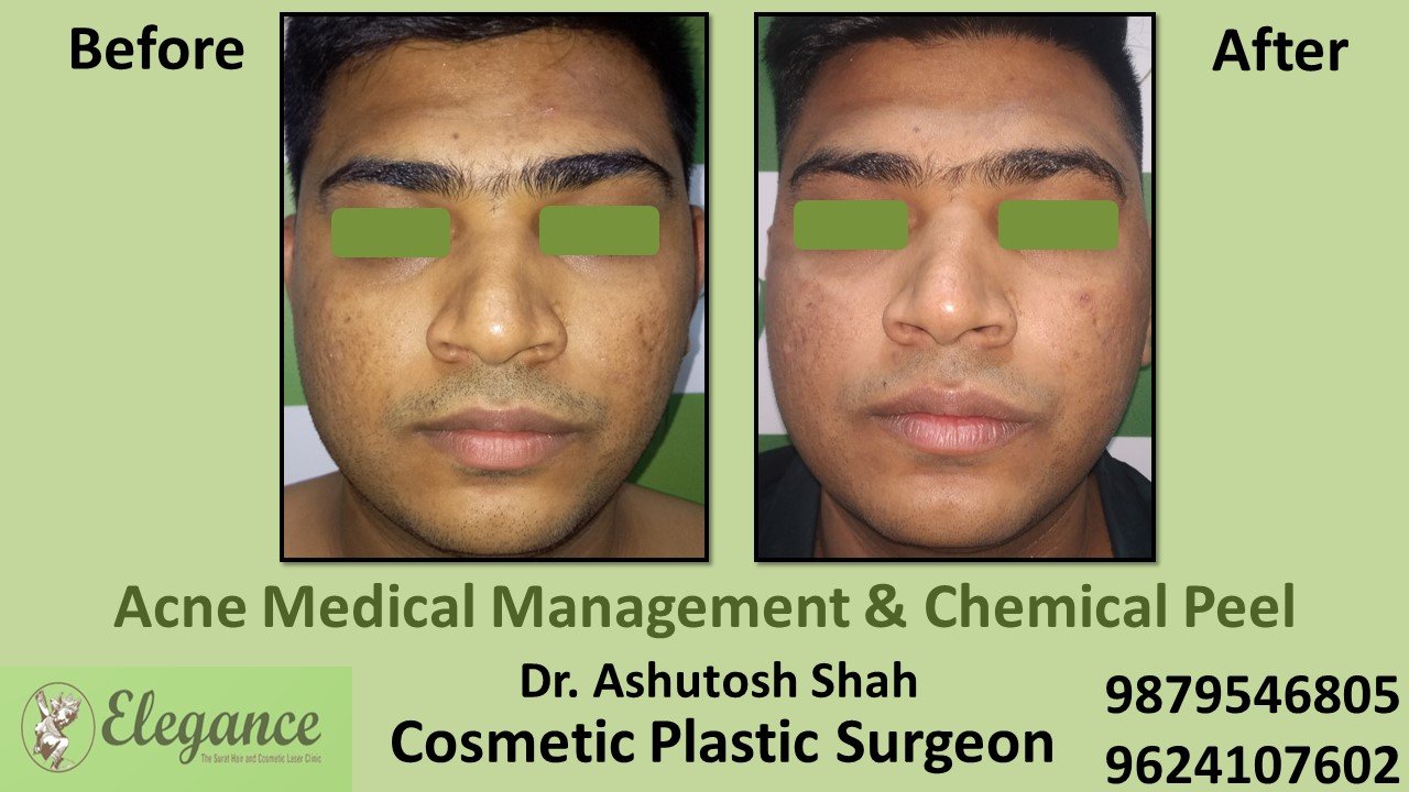 Acne - Chemical Peel, Valsad, Gujarat, India.