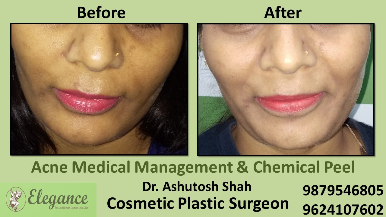 Acne - Chemical Peel, Vapi, Gujarat, India.