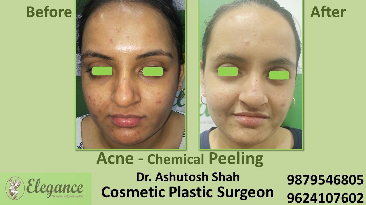 Acne Chemical Peeling Treatment  Cost In Adajan, Vesu, Piplod, Surat.