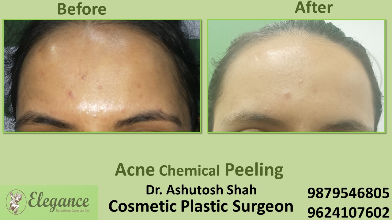 Acne Chemical Peeling Treatment In Adajan, Amroli, Dabholi,Surat.