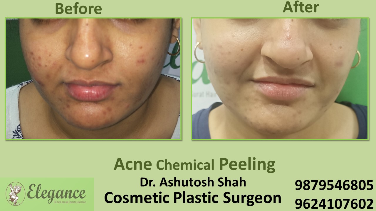 Acne Face Laser Treatment In Athwalinse, Vesu, Piplod, Surat.