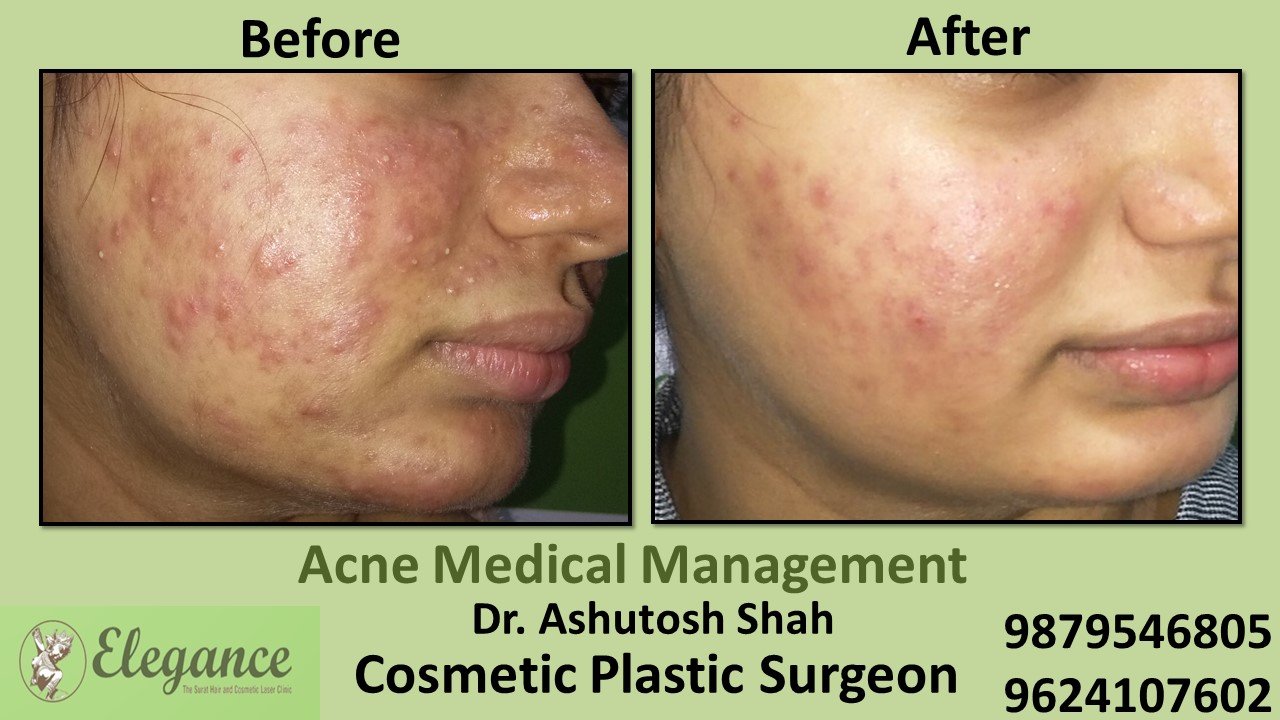 Acne Medical Management, Bardoli, Gujarat, India.