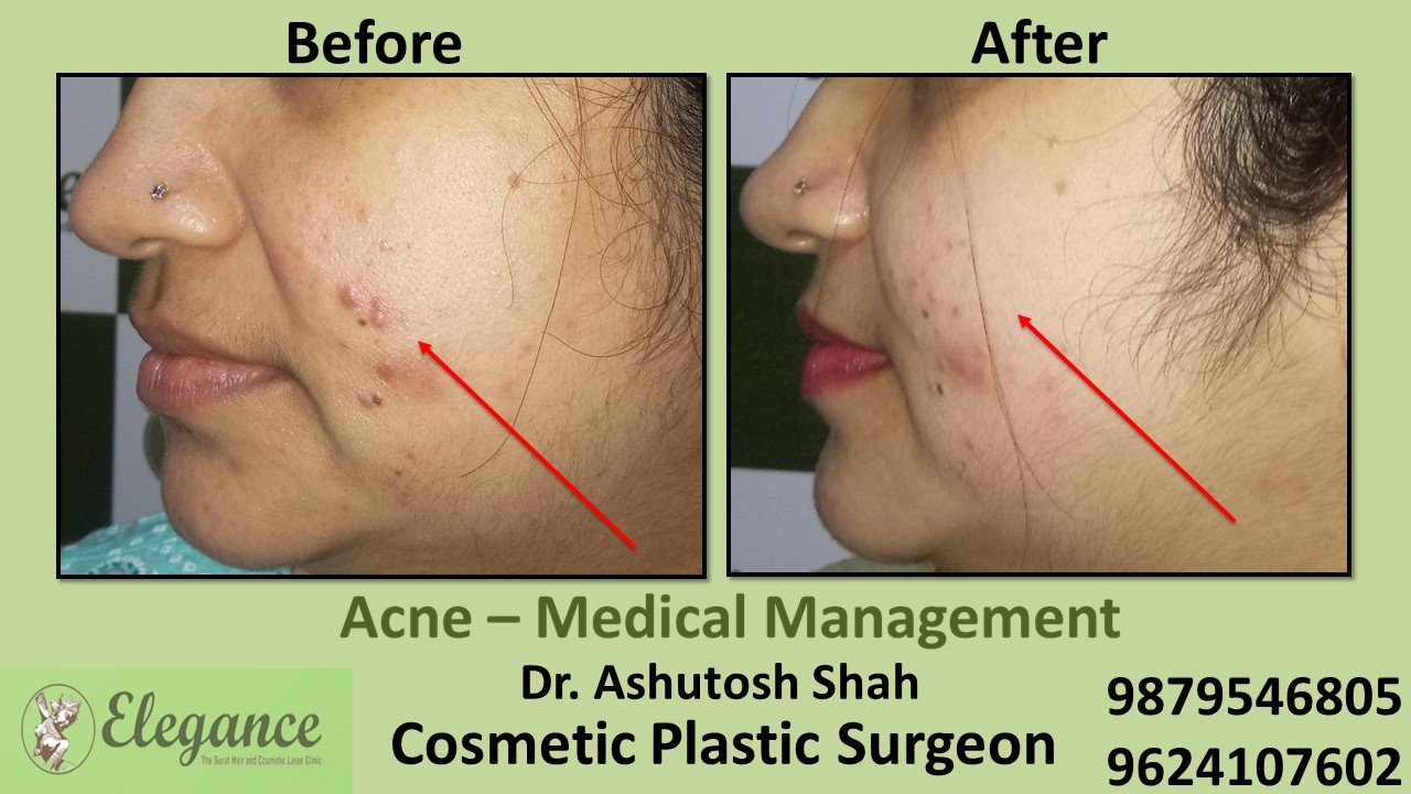 Acne Medical Management, Bharuch, Gujarat, India.