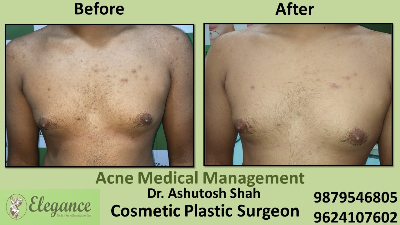 Acne Medical Management, Bilimora, Gujarat, India.