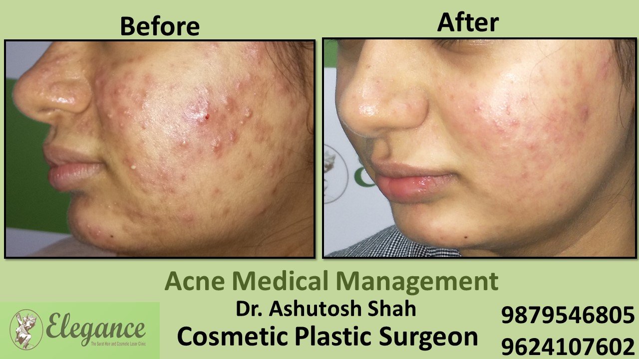 Acne Medical Management, Chhota Udaipur, Gujarat, India.