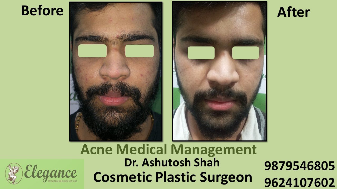 Acne Medical Management, Daman, Gujarat, India.