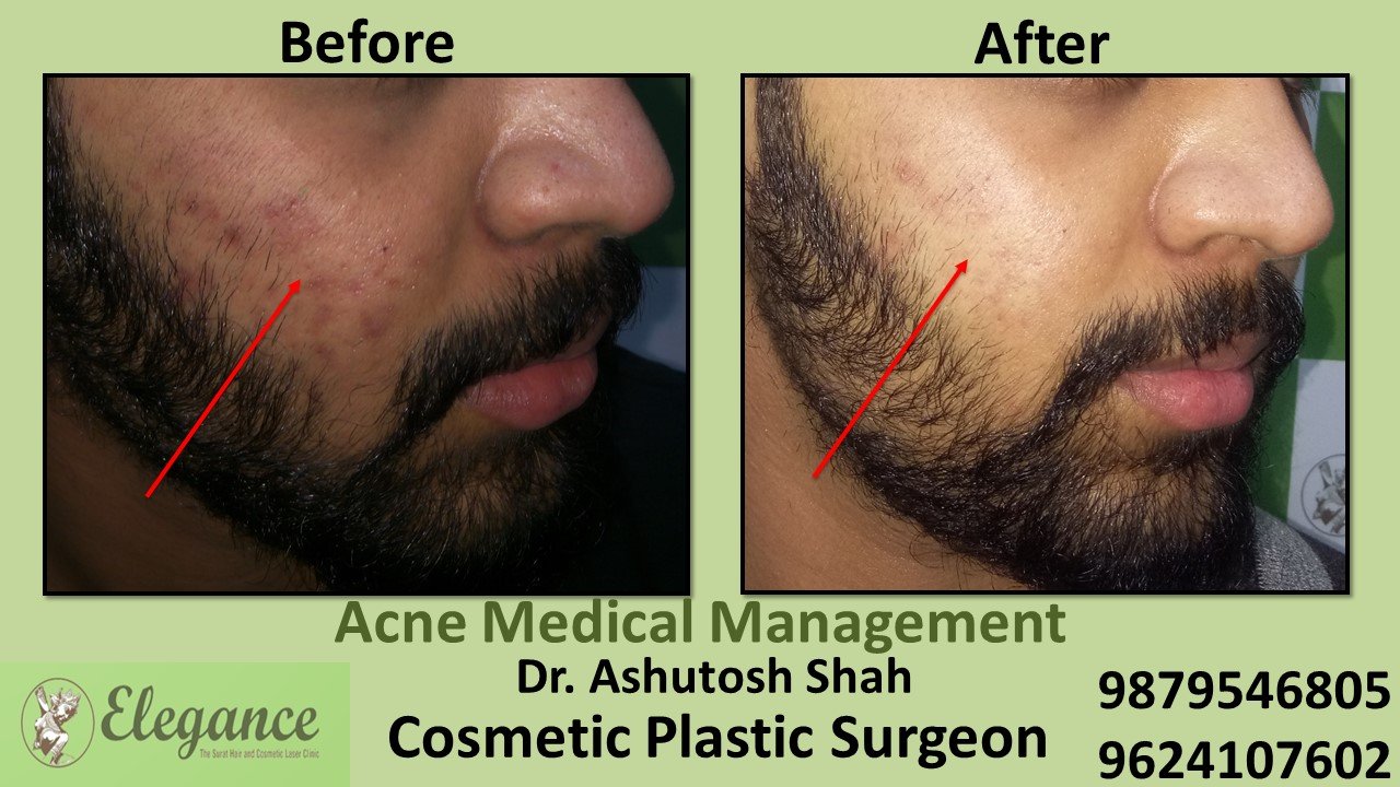 Acne Medical Management, Kim, Gujarat, India.