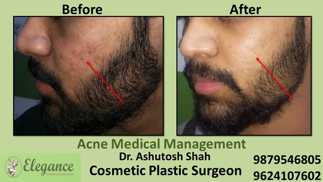 Acne Medical Management, Mangrol, Gujarat, India.