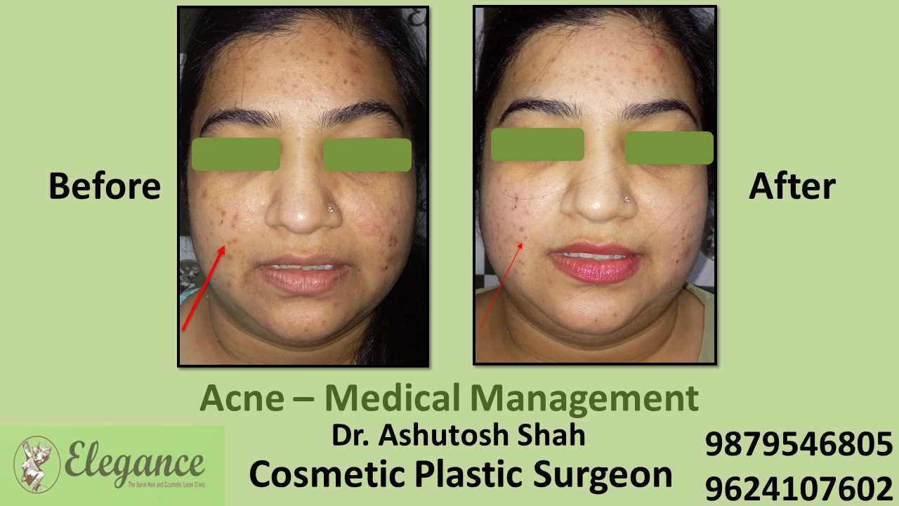 Acne Medical Management , Selvasa, Gujarat, India.