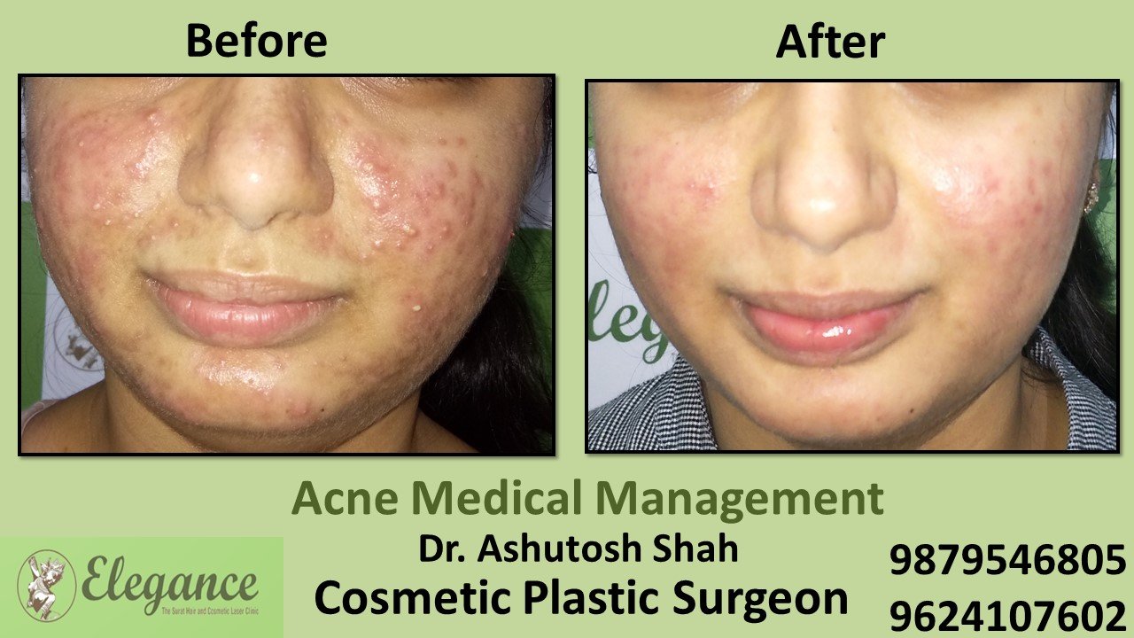 Acne Scar Management