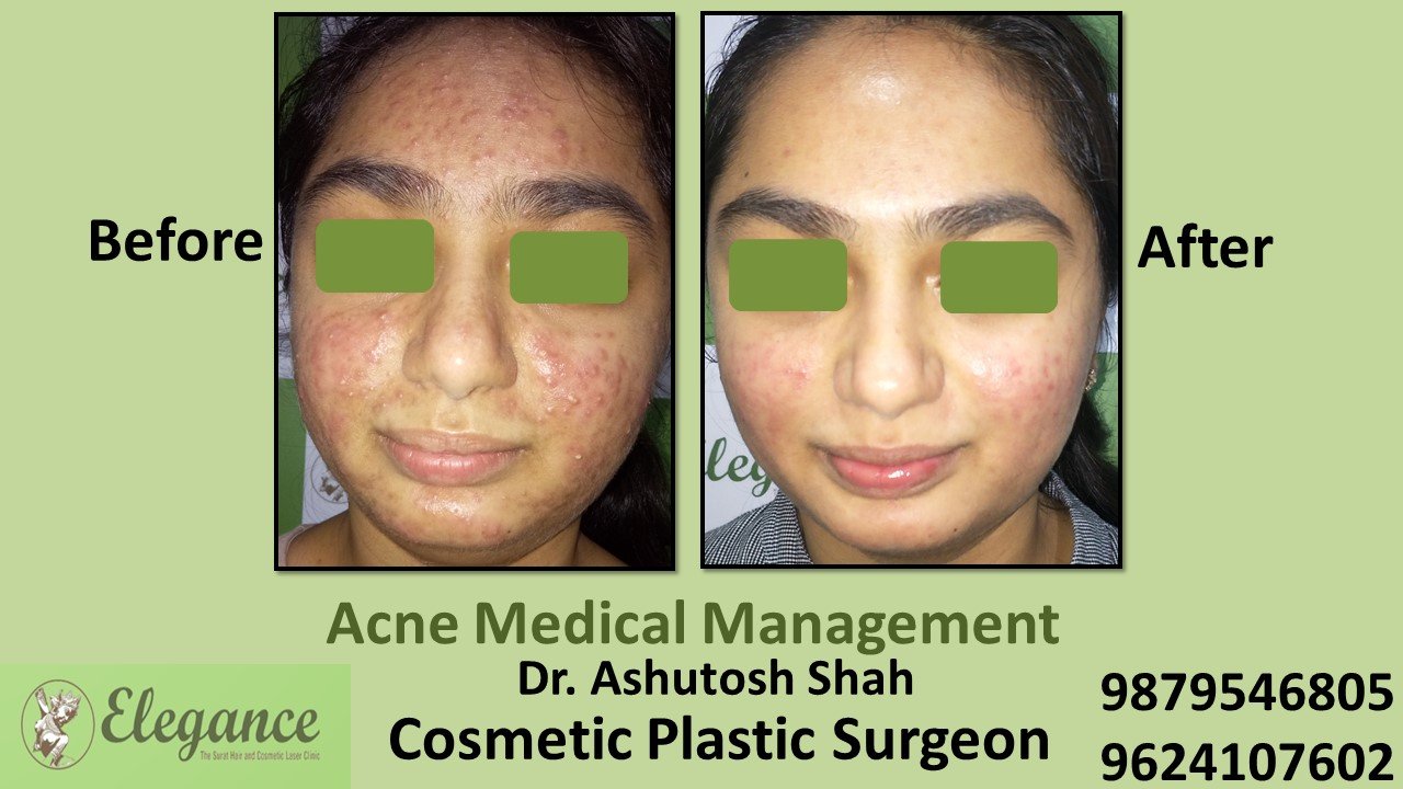 Acne Medical Management, Vapi, Gujarat, India.