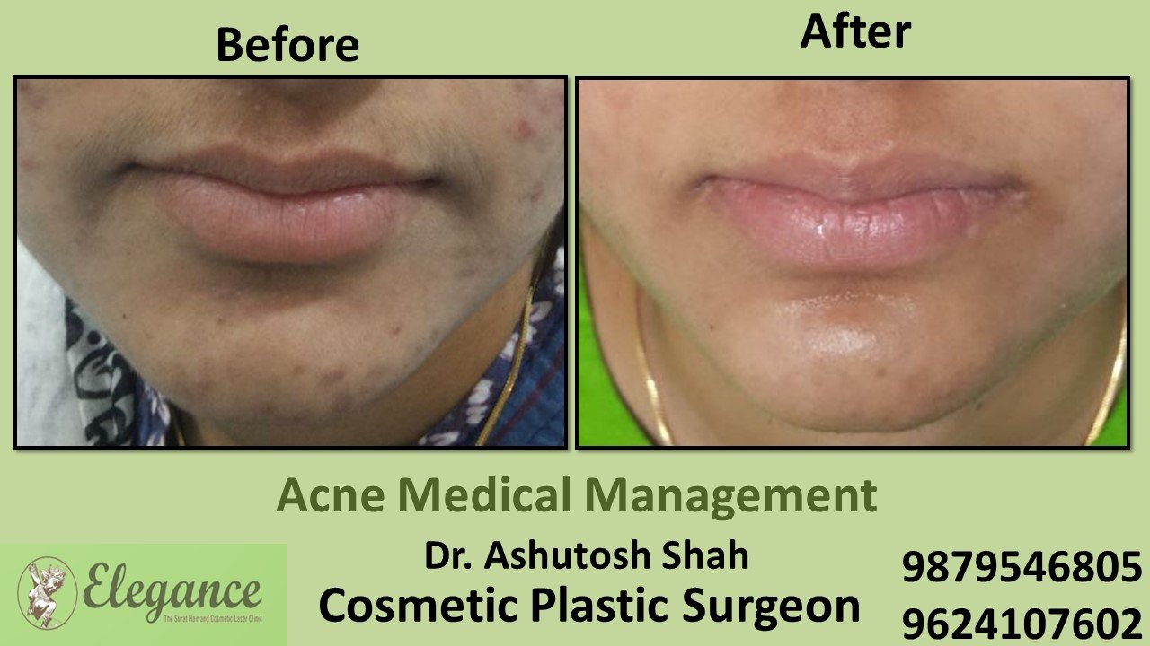 Acne Treatment and Medication, Ankleshwar, Gujarat, India.