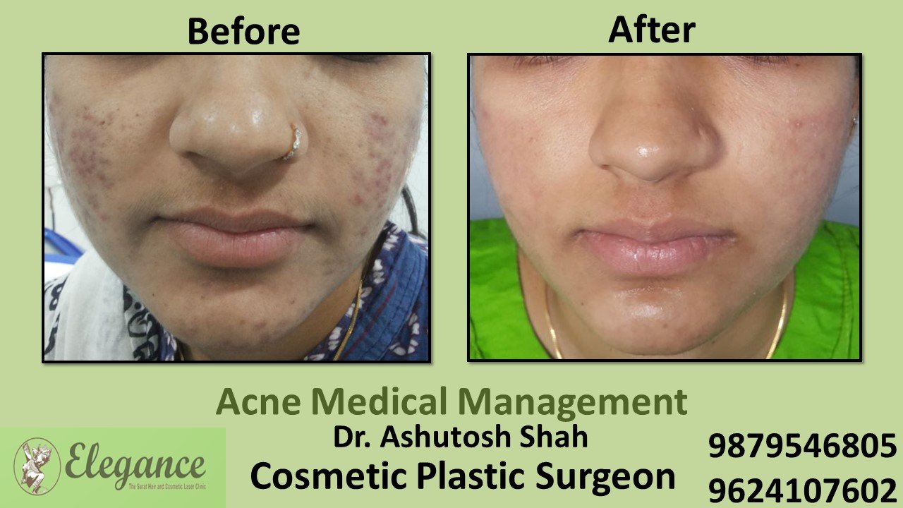 Acne Treatment and Medication, Baroda, Gujarat, India.