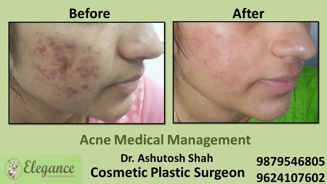 Acne Treatment and Medication, Bharuch, Gujarat, India.