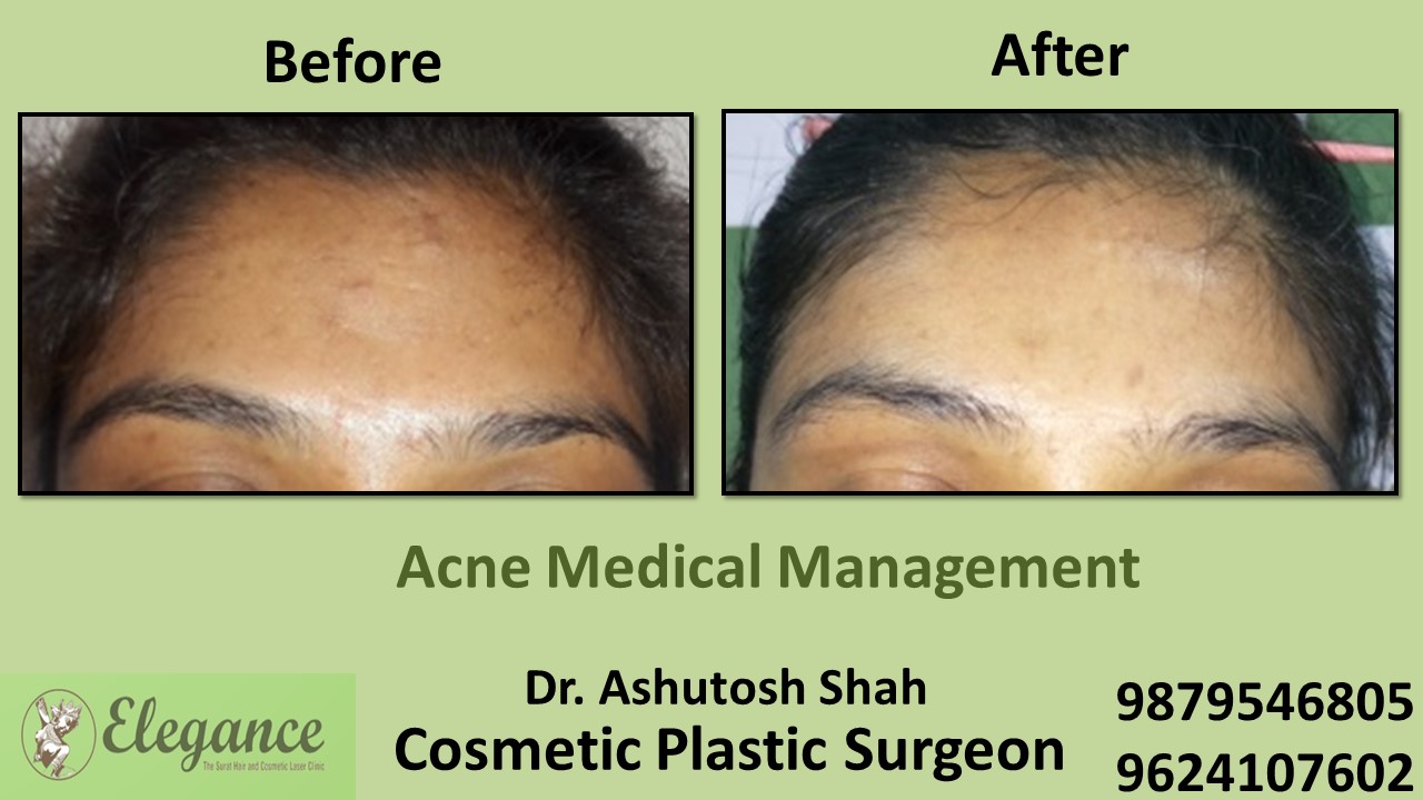 Acne Treatment and Medication, Bilimora, Gujarat, India.