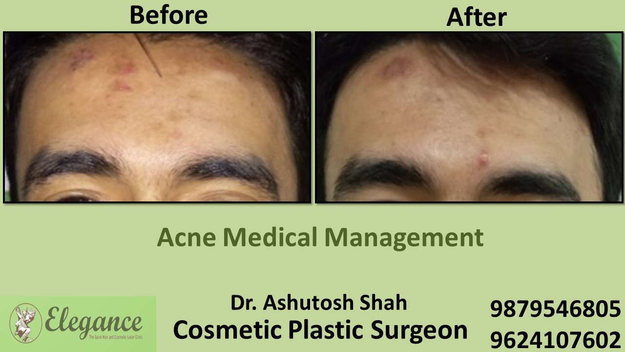 Acne Treatment and Medication, Chhota Udaipur, Gujarat, India.