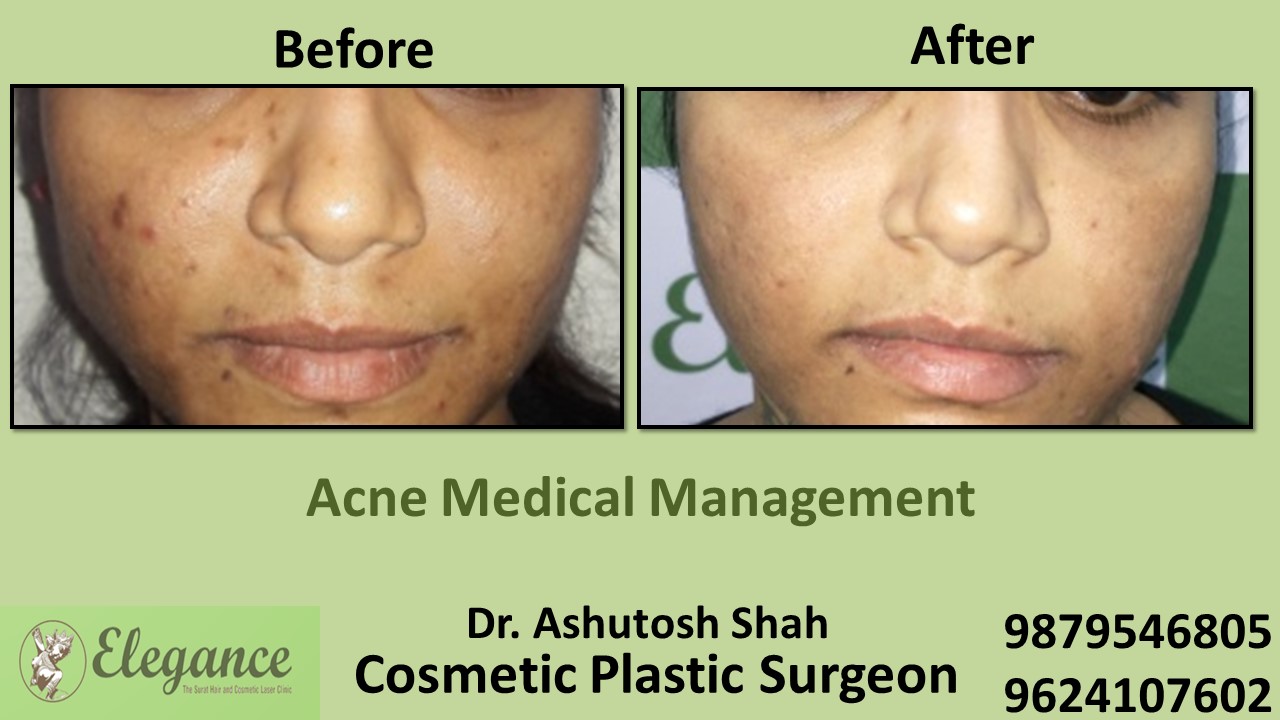 Acne Treatment and Medication, Chikhli, Gujarat, India.