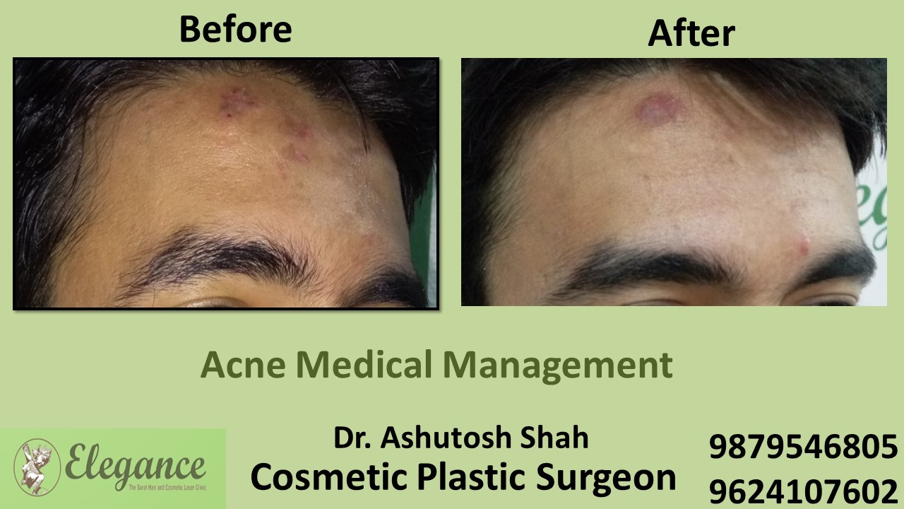 Acne Treatment and Medication, Daman, Gujarat, India.