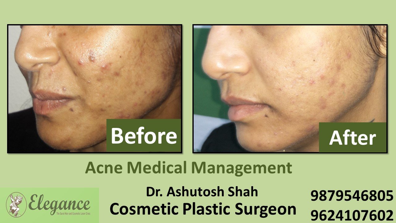 Acne Treatment and Medication, Hazira, Gujarat, India.