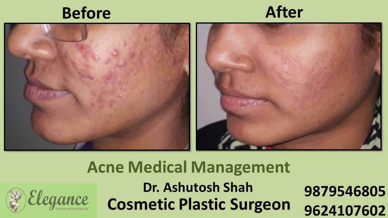 Acne Treatment and Medication, KIM, Gujarat, India.