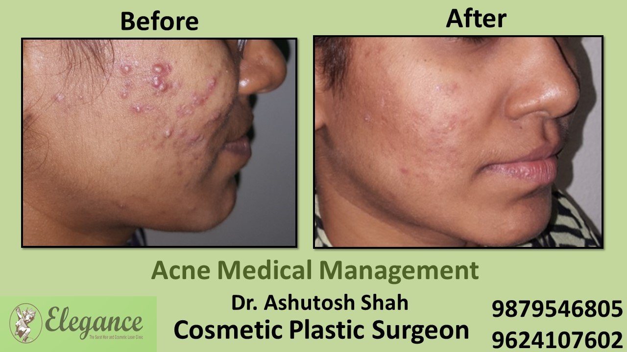 Acne Treatment and Medication, Mangrol, Gujarat, India.