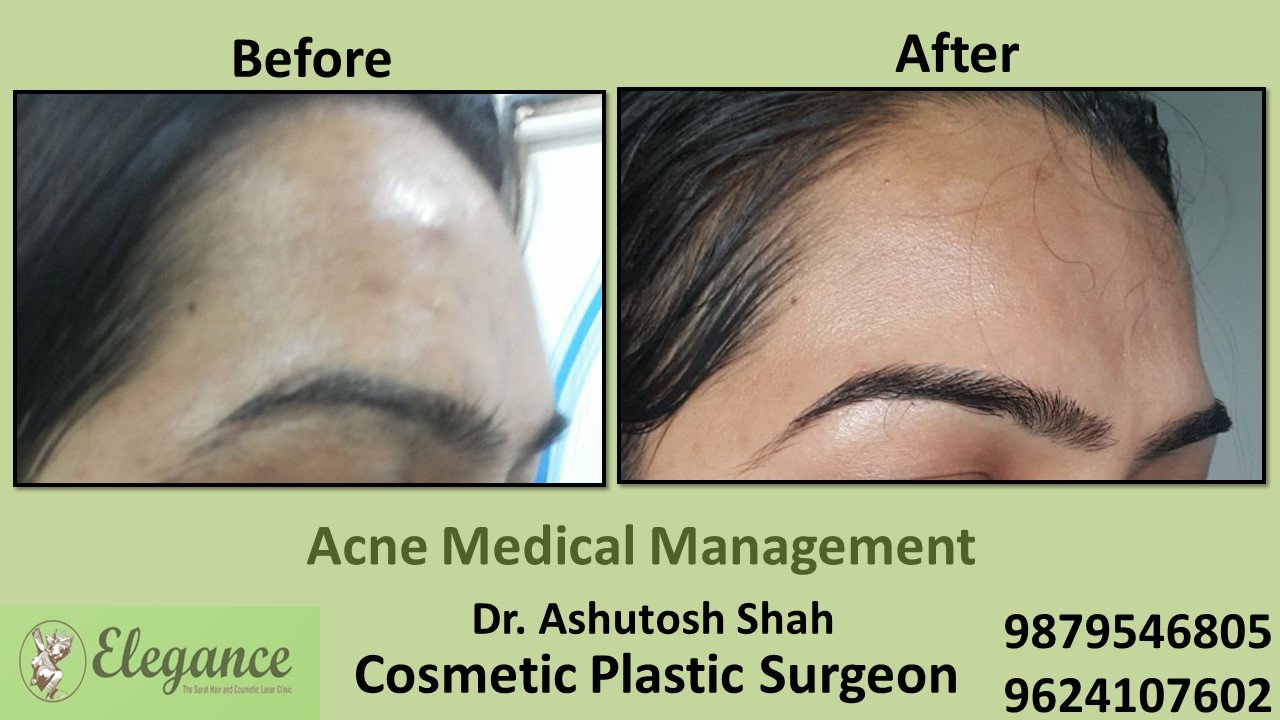 Acne Treatment and Medication, Navsari, Gujarat, India.