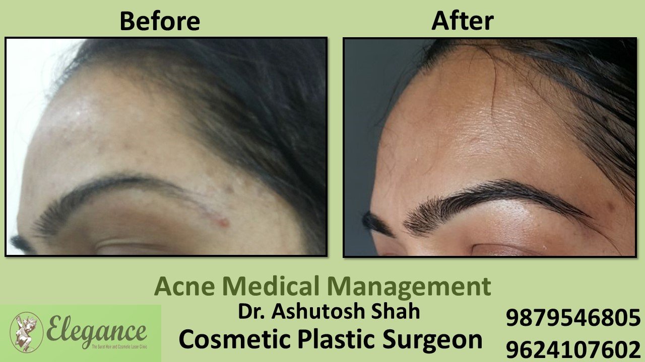 Acne Treatment and Medication, Valsad, Gujarat, India.