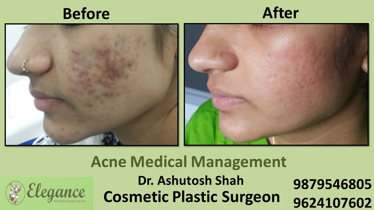 Acne Treatment and Medication, Vapi, Gujarat, India.