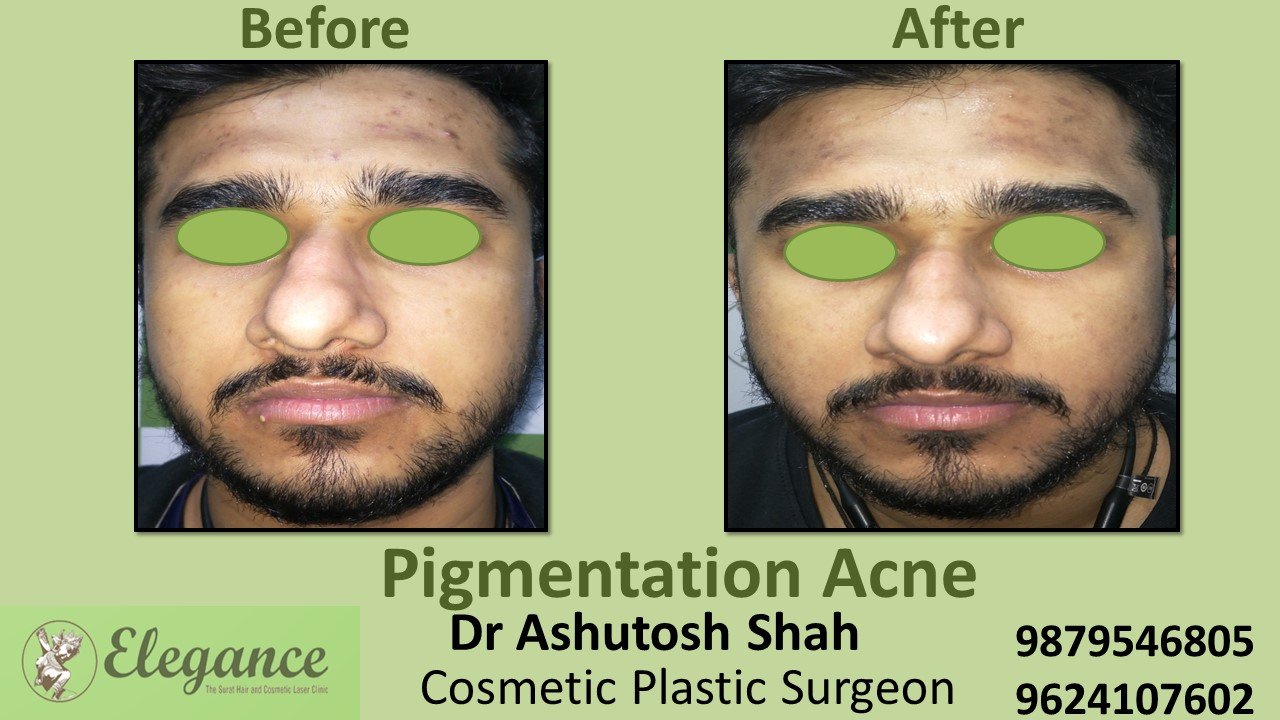 Acne Vulgaris Treatment in Bharuch, Gujarat, India.