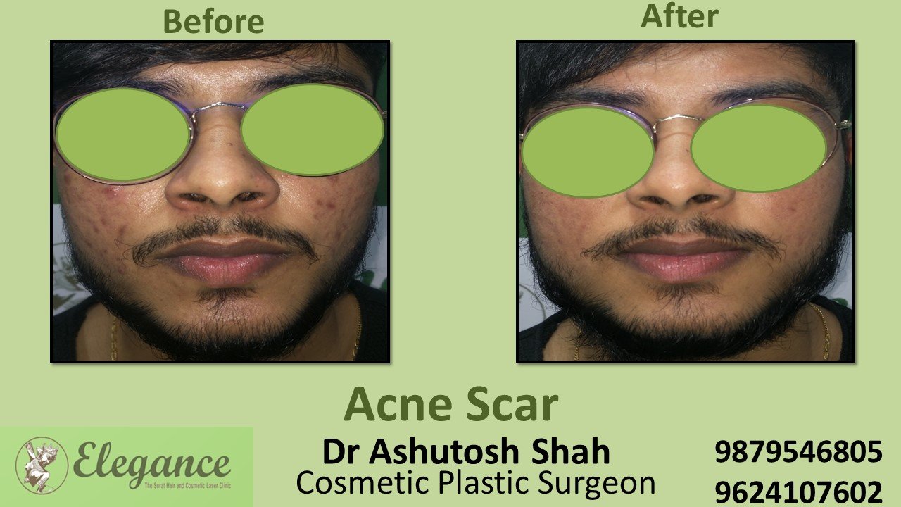 Acne Vulgaris Treatment in Chikhli, Gujarat, India.