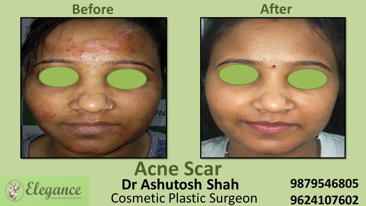 Acne Vulgaris Treatment in Navsari, Gujarat, India.