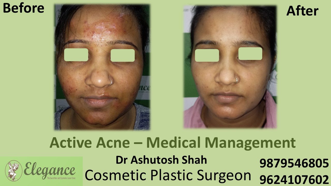 Acne Vulgaris Treatment in Surat, Gujarat, India.