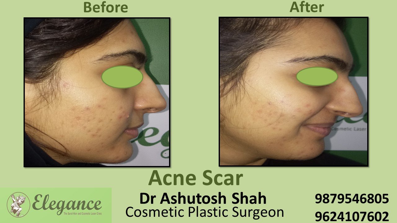 Acne Vulgaris Treatment in Vadodara, Gujarat, India.