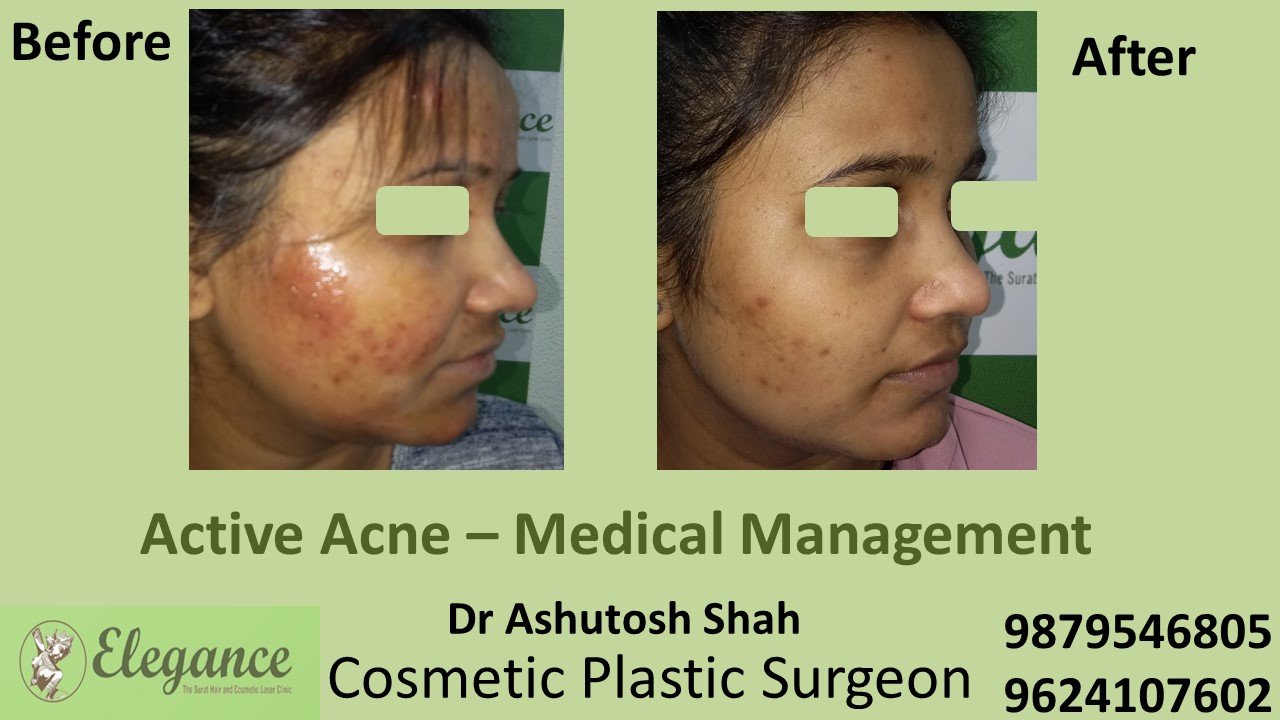 Acne Vulgaris Treatment in Valsad, Gujarat, India.