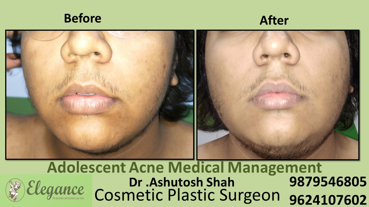 Adolescent Acne Medical Management, Surat, Gujarat, India.