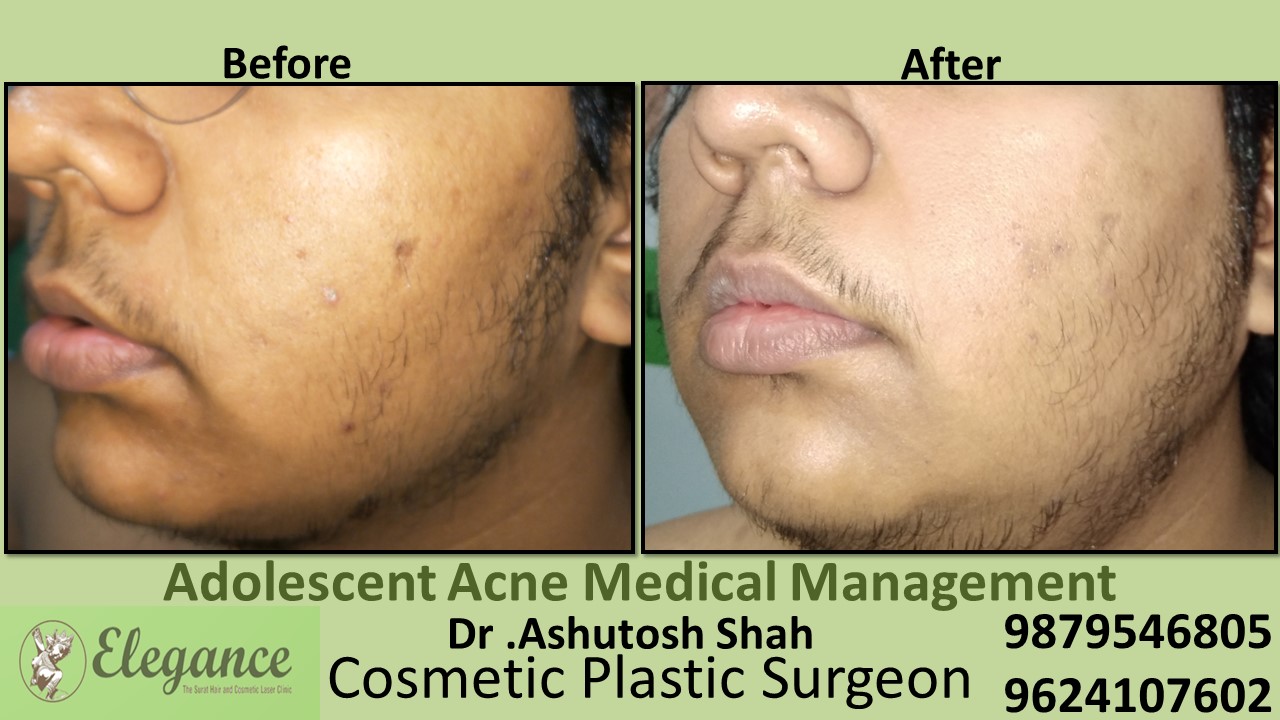 Adolescent Acne Medical Management, Valsad, Gujarat, India.