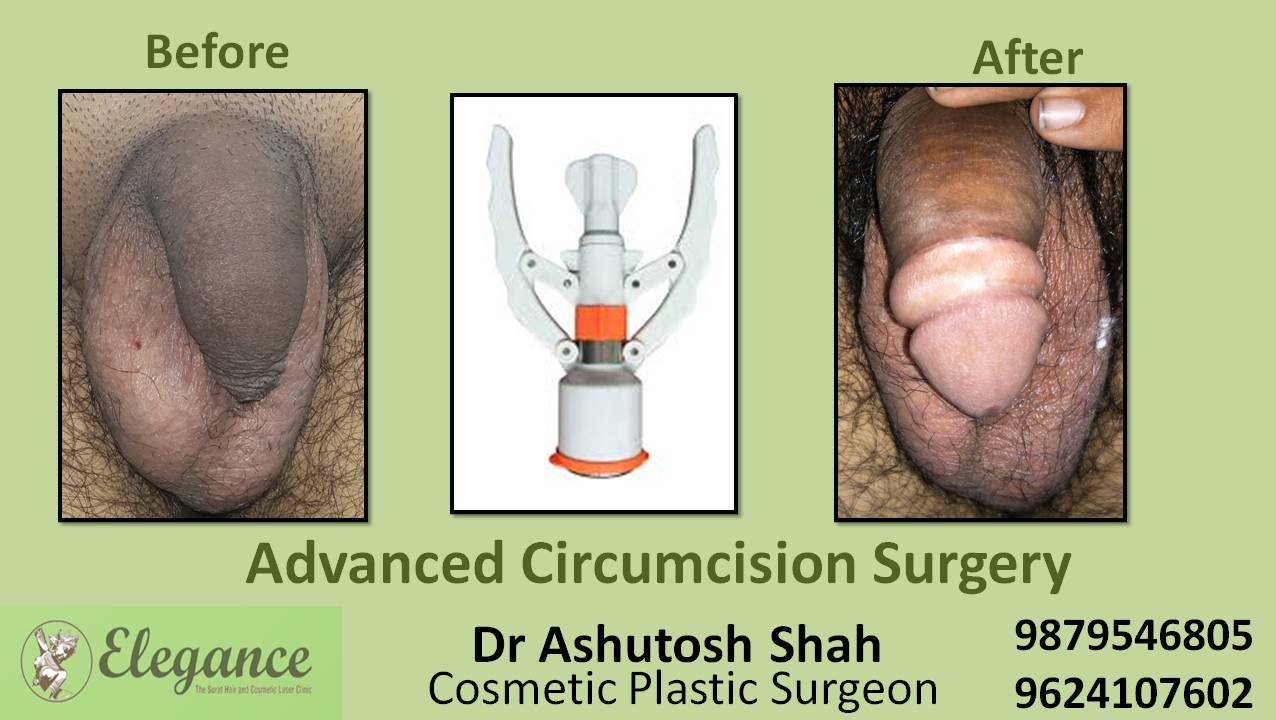 Advance Circumcision Surgery, kim, Gujarat, India