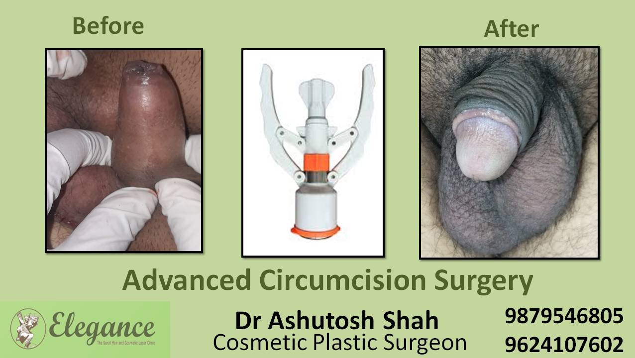 Advance Circumcision Surgery, Navsari, Gujarat, India